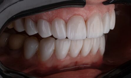 a person's mouth with teeth